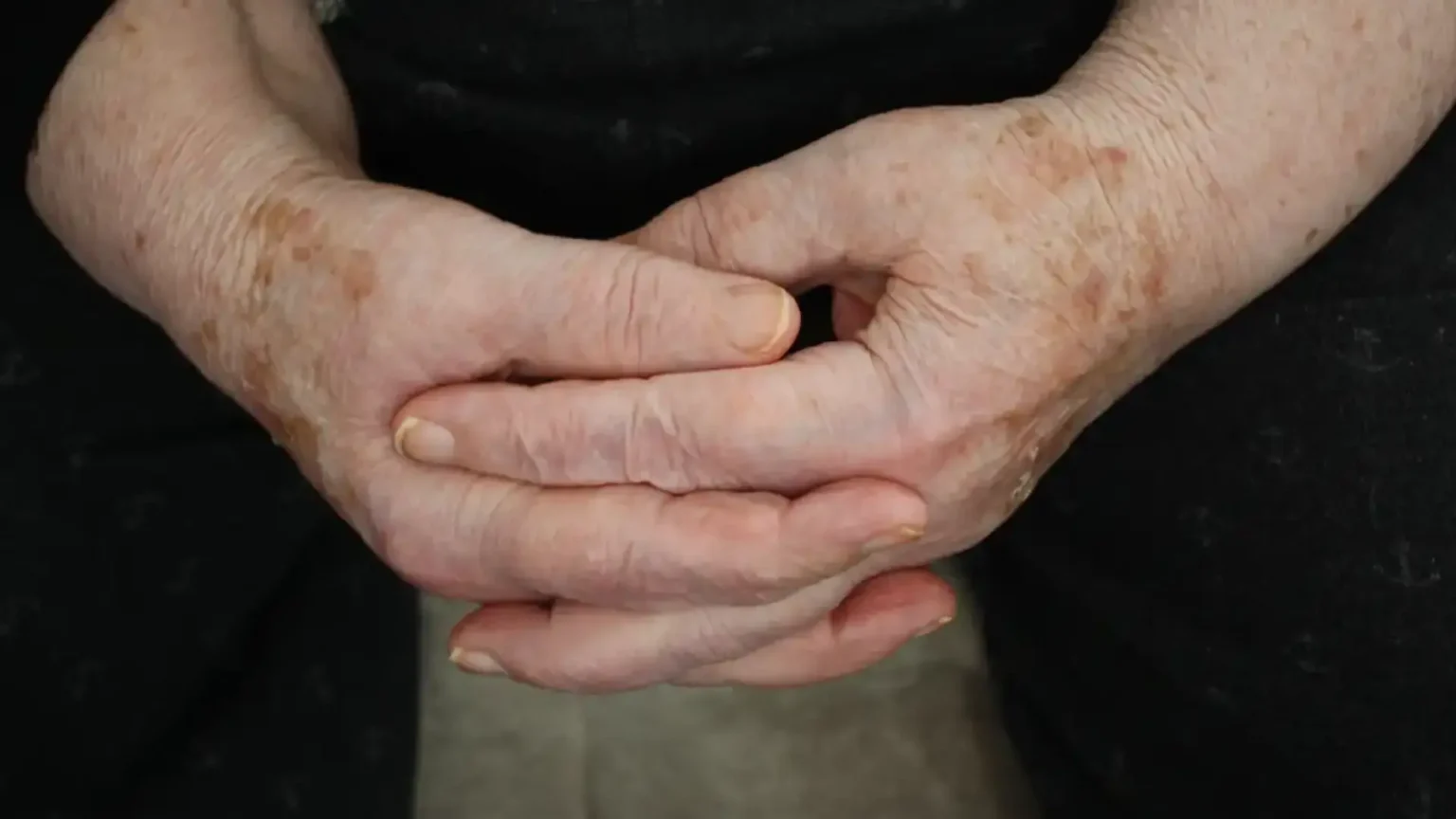 Какво представляват старческите петна и защо се появяват по кожата