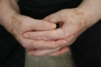 Какво представляват старческите петна и защо се появяват по кожата