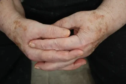 Какво представляват старческите петна и защо се появяват по кожата