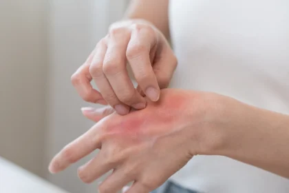 Натурално решение при обриви: 9 доказани бабини рецепти с билки и домашни средства