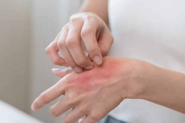 Натурално решение при обриви: 9 доказани бабини рецепти с билки и домашни средства